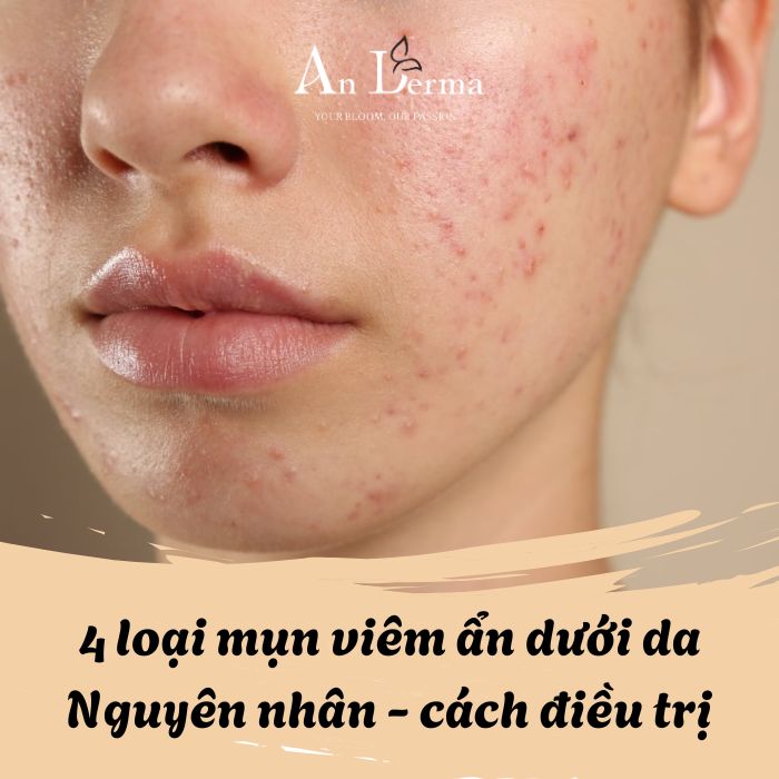 4 loại mụn viêm ẩn dưới da, nguyên ngân và cách điều trị