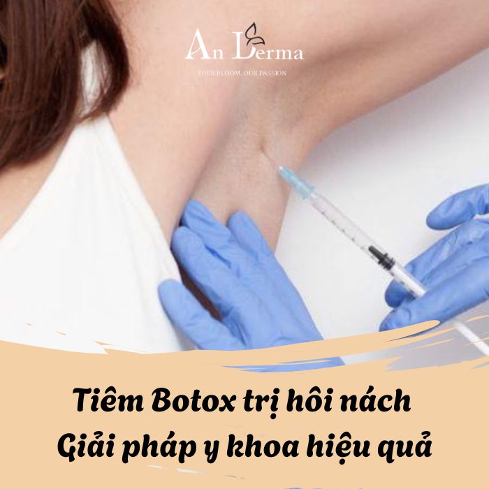 Tiêm Botox trị hôi nách – 1 Giải pháp y khoa hiệu quả