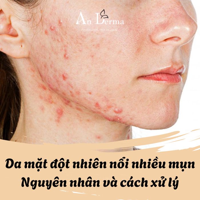 Da mặt đột nhiên nổi nhiều mụn – 5 Nguyên nhân và cách xử lý