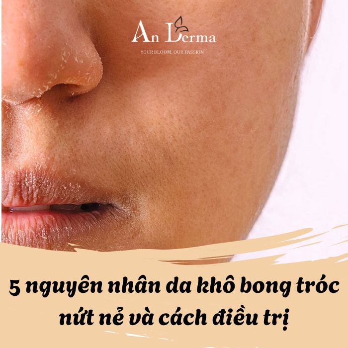 5 Nguyên Nhân Da Khô Bong Tróc Nứt Nẻ Và Cách Điều Trị