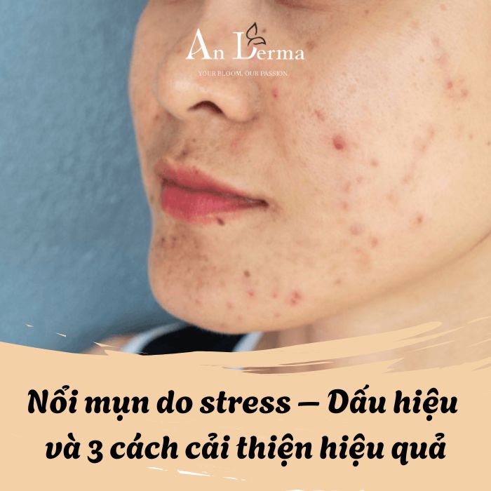 Nổi mụn do stress – Dấu hiệu và 3 cách cải thiện hiệu quả