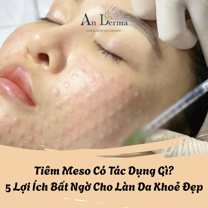 Tiêm meso có tác dụng gì? Phương pháp giúp làn da tươi trẻ, rạng rỡ